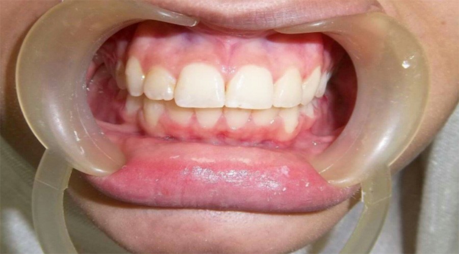 بعد تقويم وعلاج الاسنان بمركز دكتور ايمن الغمراوى -تركيب وتجميل الاسنان 3